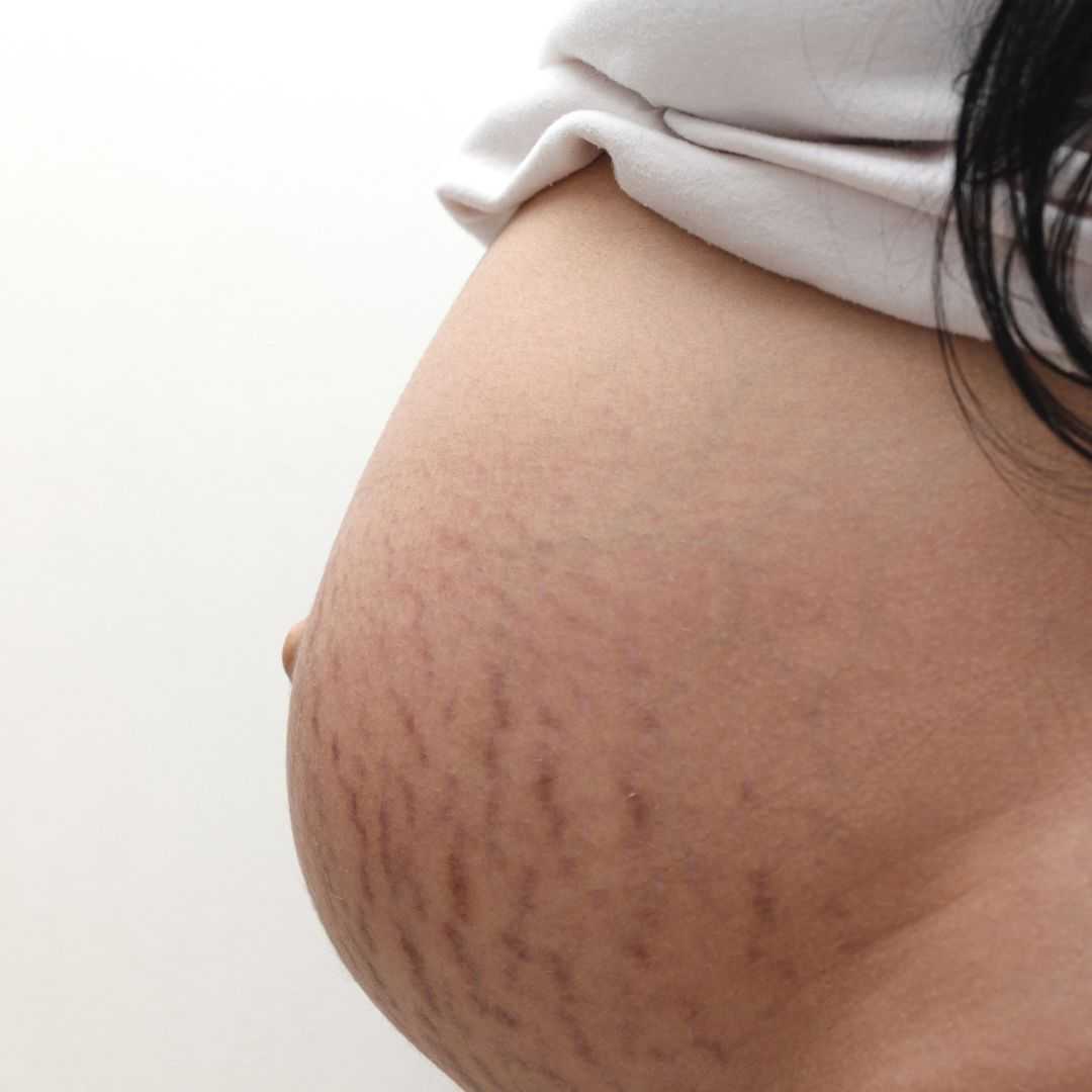 "Stretch Mark" Saat Hamil